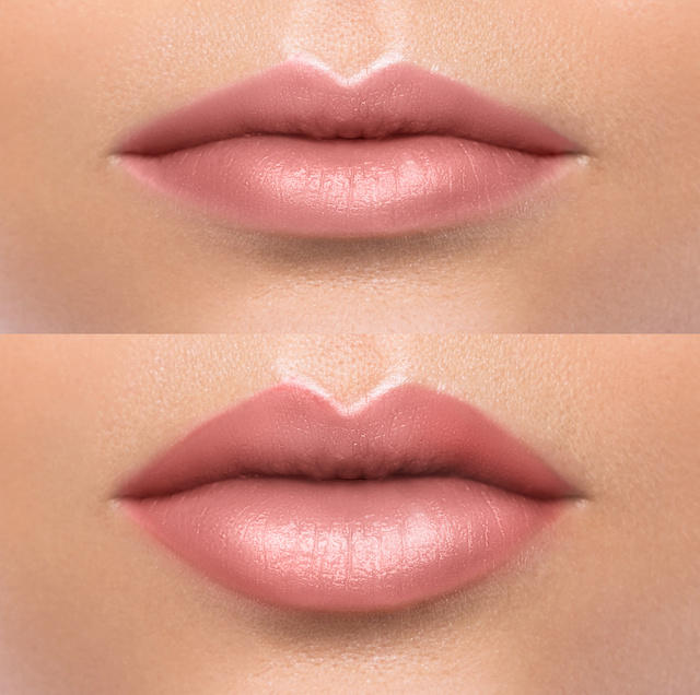Comparison of Female Lips after Augmentation